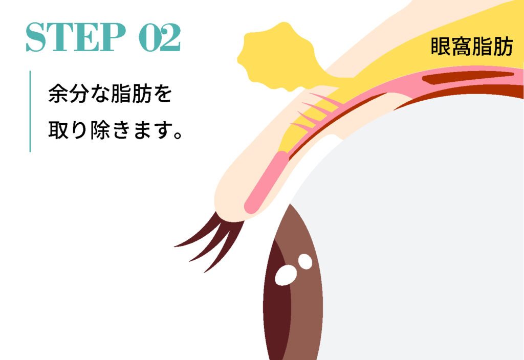 手術：数ミリの傷から、脂肪を取り出します。5分ほどで終わります。もちろん傷跡は残りません。