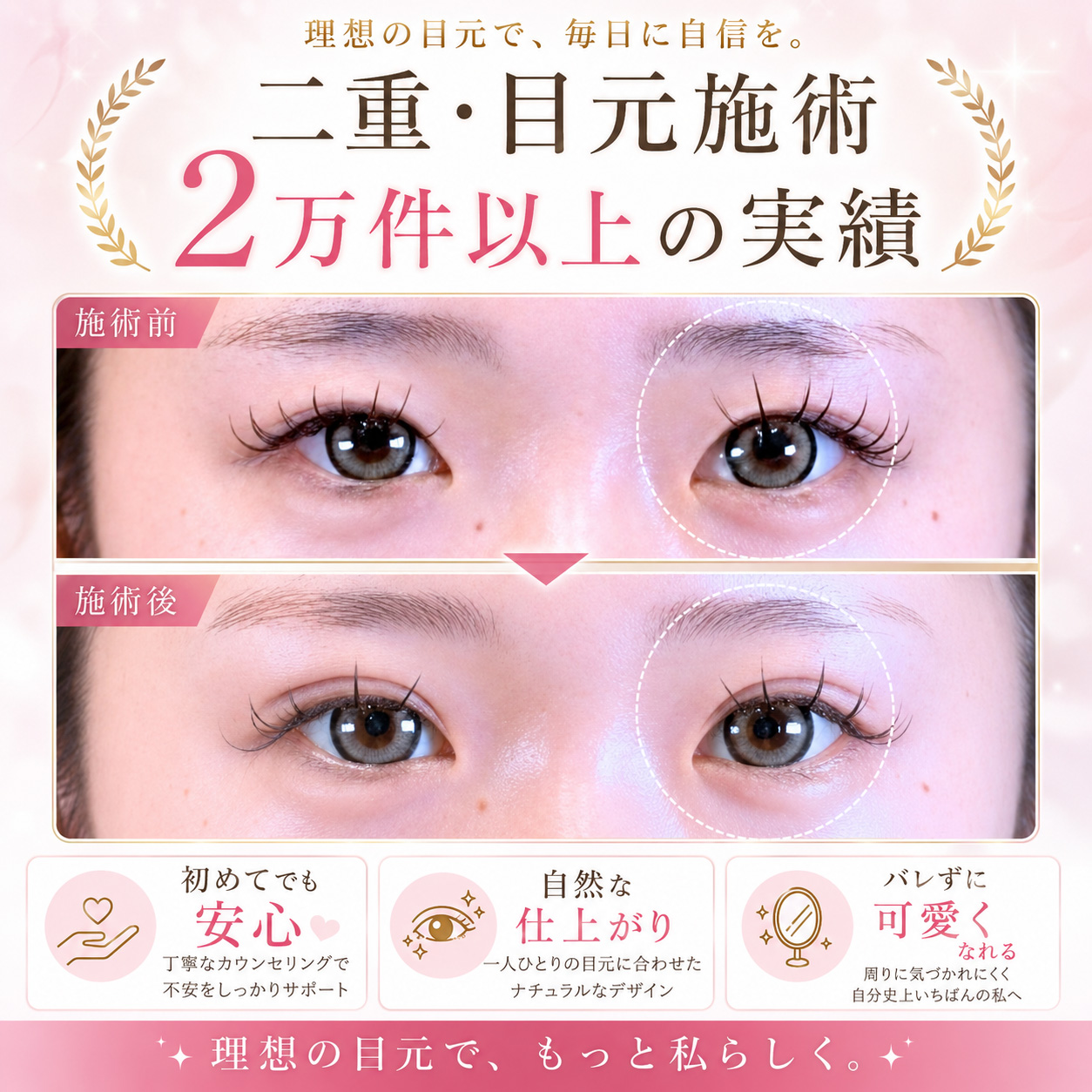 Leap beauty clinicの二重・目元施術症例。二重・目元施術20,000件以上の実績。初めての二重整形でも安心、自然な仕上がり、バレにくく可愛くなれる目元デザインを提案。