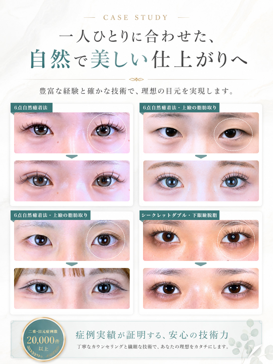 Leap beauty clinicの二重整形症例集。6点自然癒着法、上瞼の脂肪取り、シークレットダブル、下瞼脱脂など、一人ひとりに合わせた自然で美しい目元施術の症例を掲載。