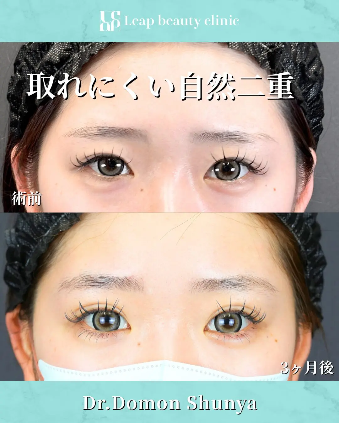二重埋没法の症例写真 1