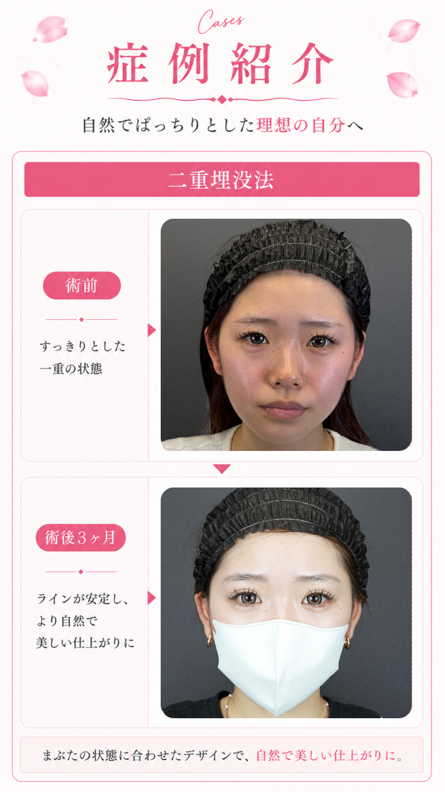 症例紹介。二重埋没法の術前と術後3ヶ月の比較。
