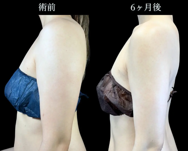 二の腕 術前→術後