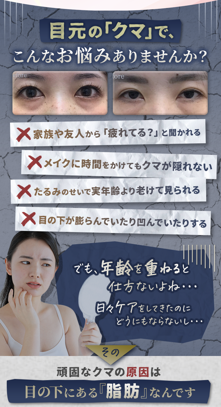 目元の「クマ」で、こんな悩みありますか? ×家族や友人から「疲れてる?」と聞かれる ×メイクに時間をかけてもクマが隠れない ×たるみのせいで実年齢より老けて見られる ×目の下が膨らんでいたり凹んでいたりする でも、年齢を重ねると仕方ないよね・・・ 日々ケアをしてきたのにどうにもならないし・・・ その頑固なクマの原因は目の下にある「脂肪」なんです