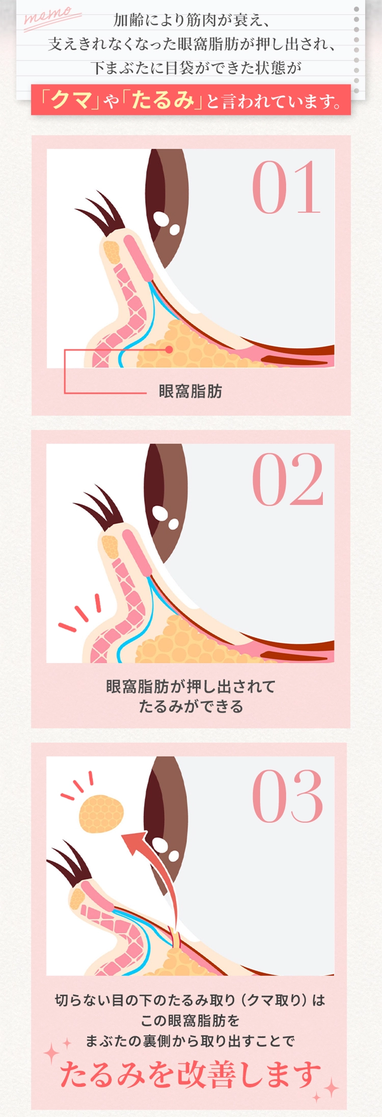 memo 加齢により筋肉が衰え、支えきれなくなった眼窩脂肪が押し出され、下まぶたに目袋が出来た状態が「クマ」や「たるみ」と言われています。01 眼下脂肪 02 眼下脂肪が押し出されてたるみができる 03 切らない目の下のたるみ取り(クマ取り)はこの眼下脂肪をまぶたの裏側から取り出すことでたるみを改善します