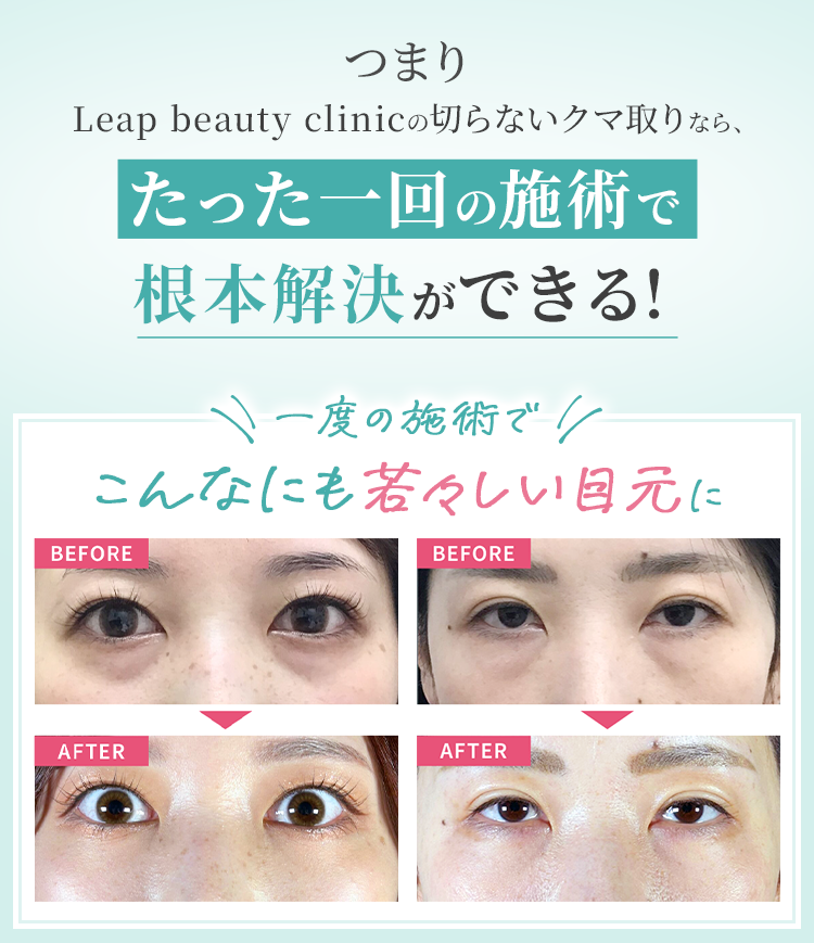 つまりLeap beauty clinicの切らないクマ取りなら、たった一回の施術で根本解決ができる! 一度の施術でこんなにも若々しい目元