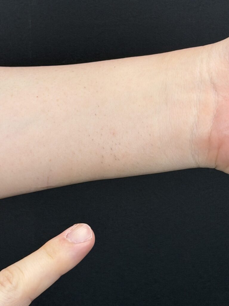 硬毛化の症例２