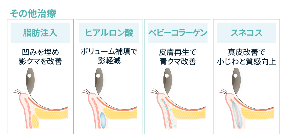 目の下のクマに用いる注入・注射治療（脂肪注入・ヒアルロン酸・ベビーコラーゲン・スネコス）