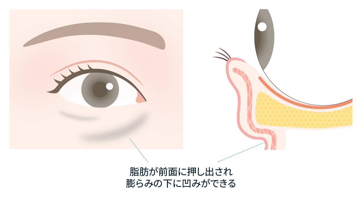 眼窩脂肪が押し出されて目の下にふくらみができ、その下にくぼみが生じる仕組み