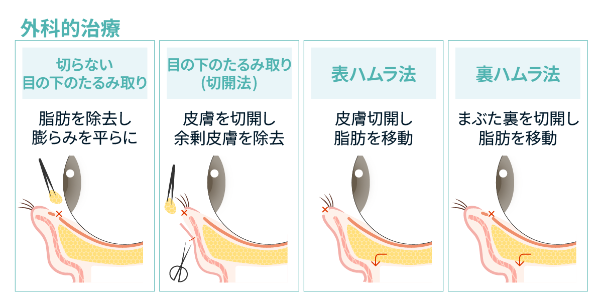 切らない目の下のたるみ取り・目の下のたるみ取り(切開法)・表ハムラ法・裏ハムラ法のアプローチの違い