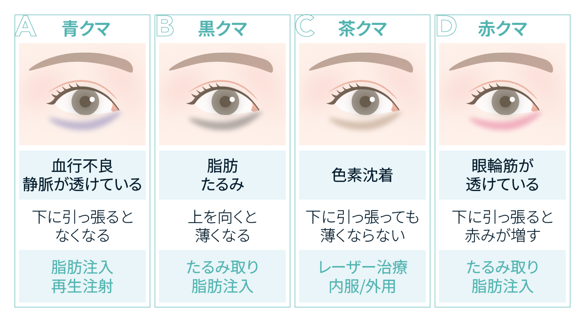 目の下のクマ4種類（青クマ・黒クマ・茶クマ・赤クマ）の原因と見分け方