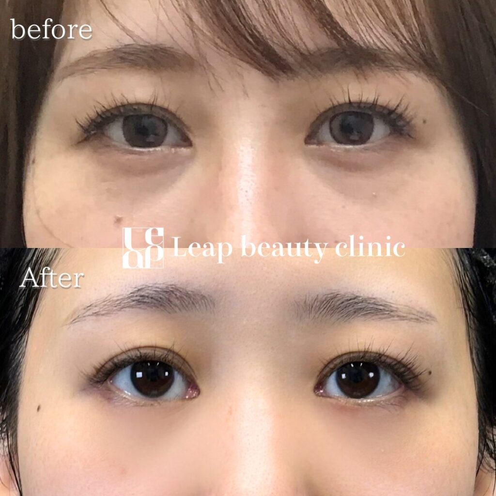 宇都宮院の裏ハムラ法の症例写真 30代女性