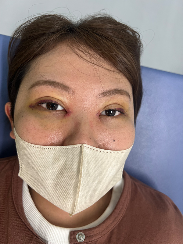 【症例写真：術直後の腫れた状態】