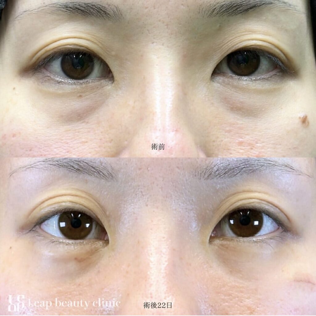 宇都宮院の裏ハムラ法の症例写真 30代女性