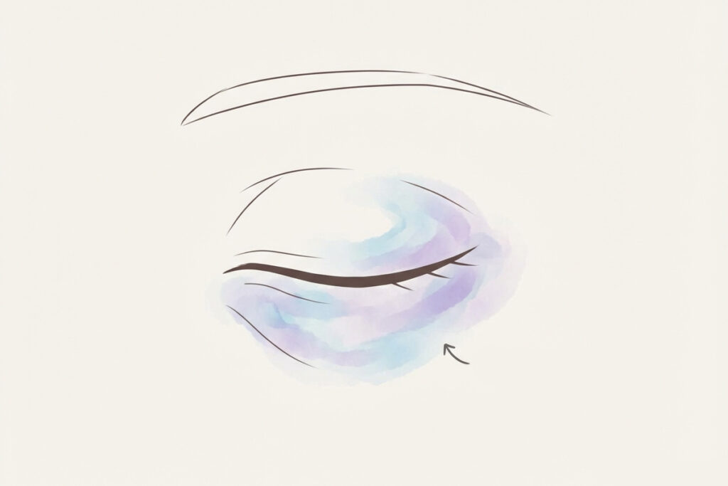 二重埋没後にまぶたから出る内出血とは?