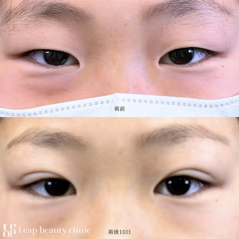 症例写真：二重埋没施術直後から10日間の内出血の経過