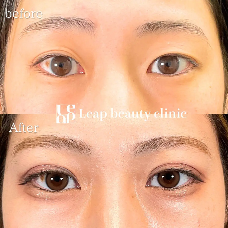 症例写真：明らかに左右の二重幅が異なる状態。片方は平行型、もう片方は末広型など、形が異なっている目元の写真