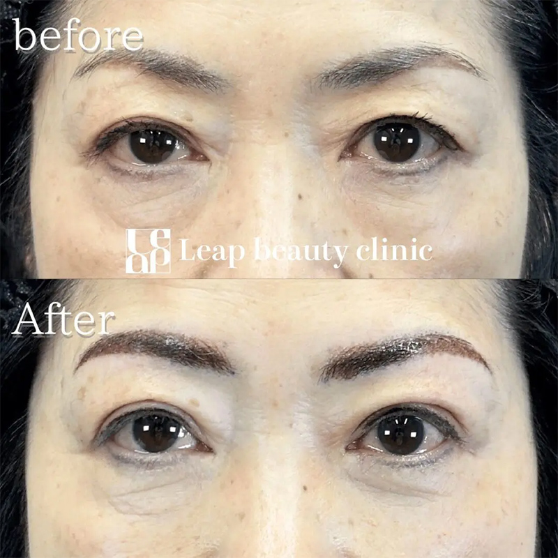 【症例写真：目が開きにくく眠そうに見える状態（眼瞼下垂）、または目が完全に閉じきらず白目が見える状態（兎眼）の写真】