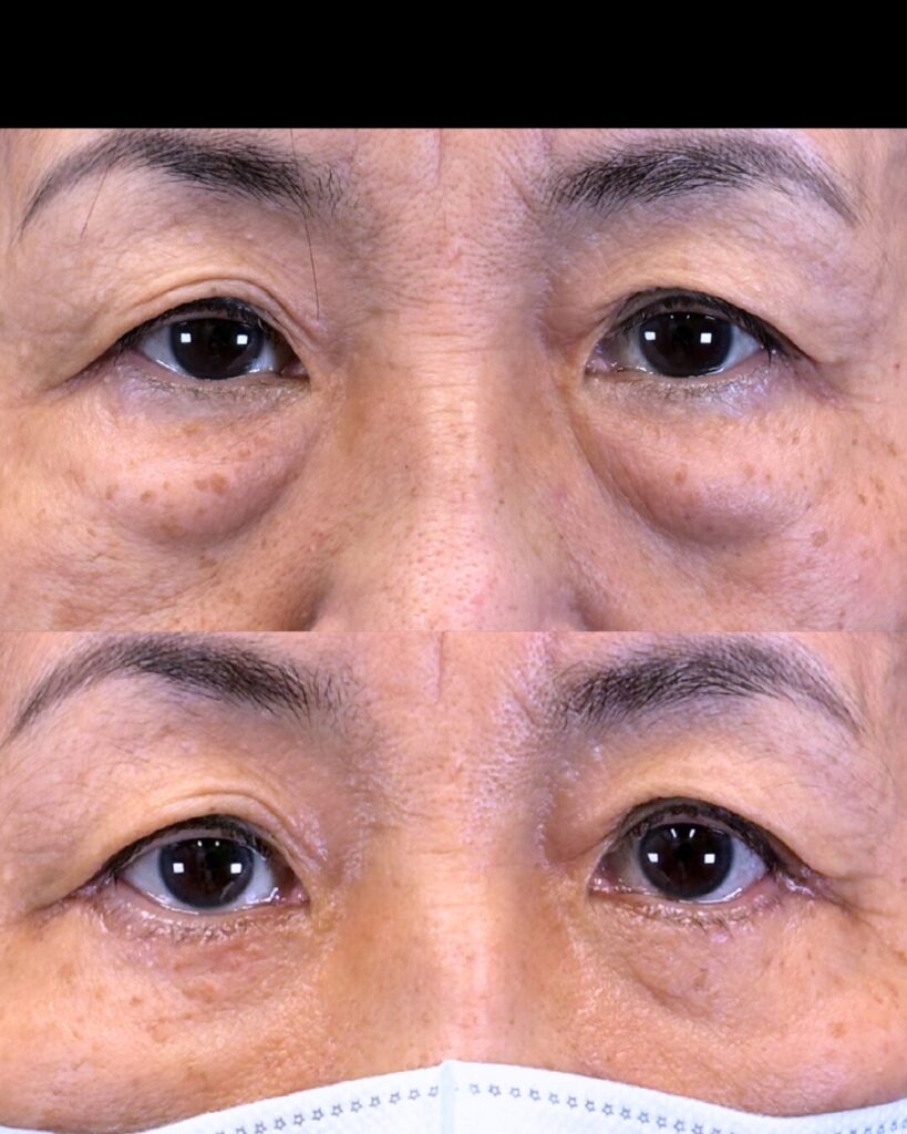 宇都宮院の表ハムラ法の症例写真 50代女性