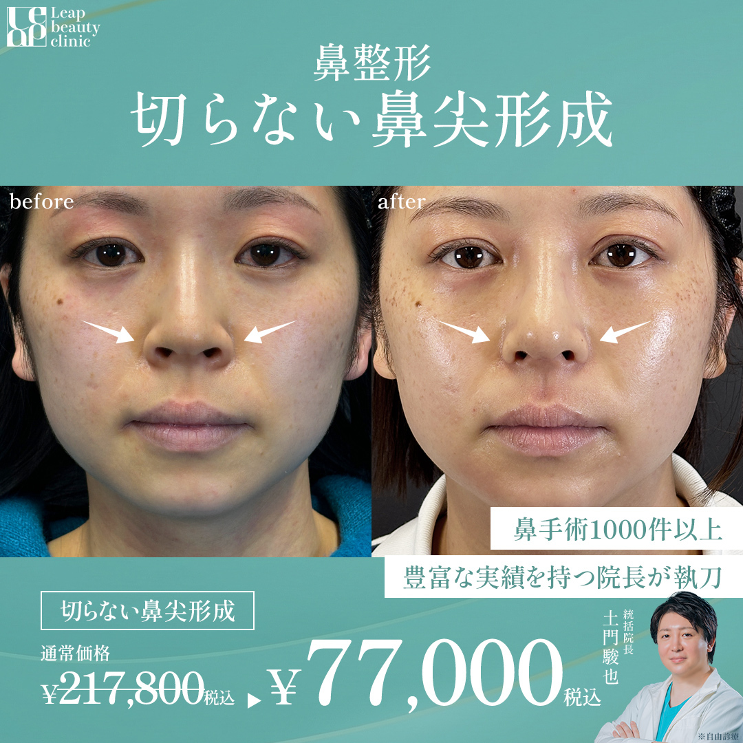 鼻尖形成 症例