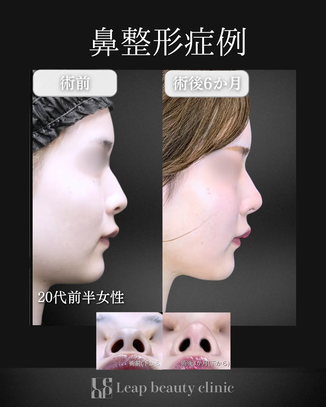 宇都宮院の鼻整形の症例写真1