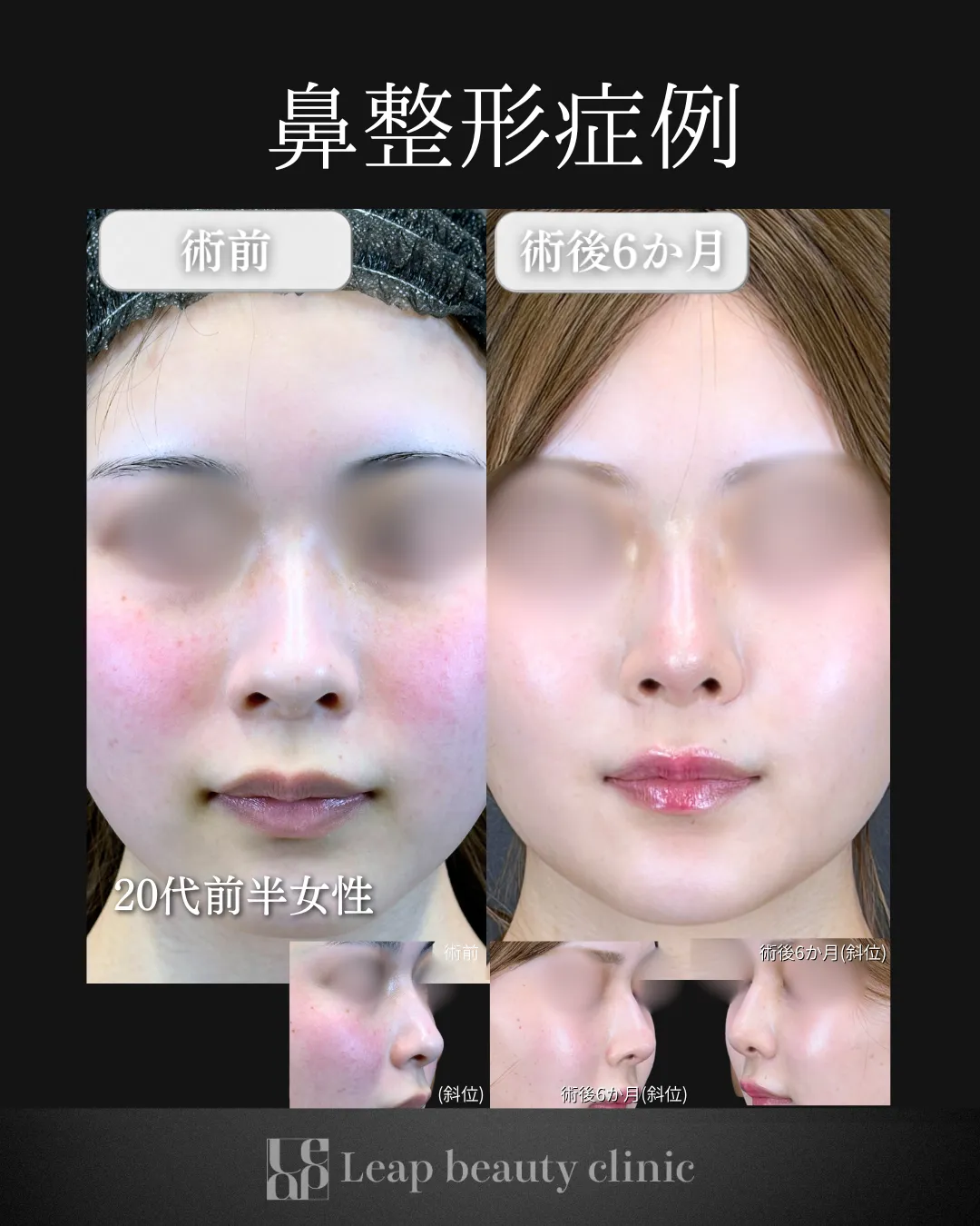 宇都宮院の鼻整形の症例写真2
