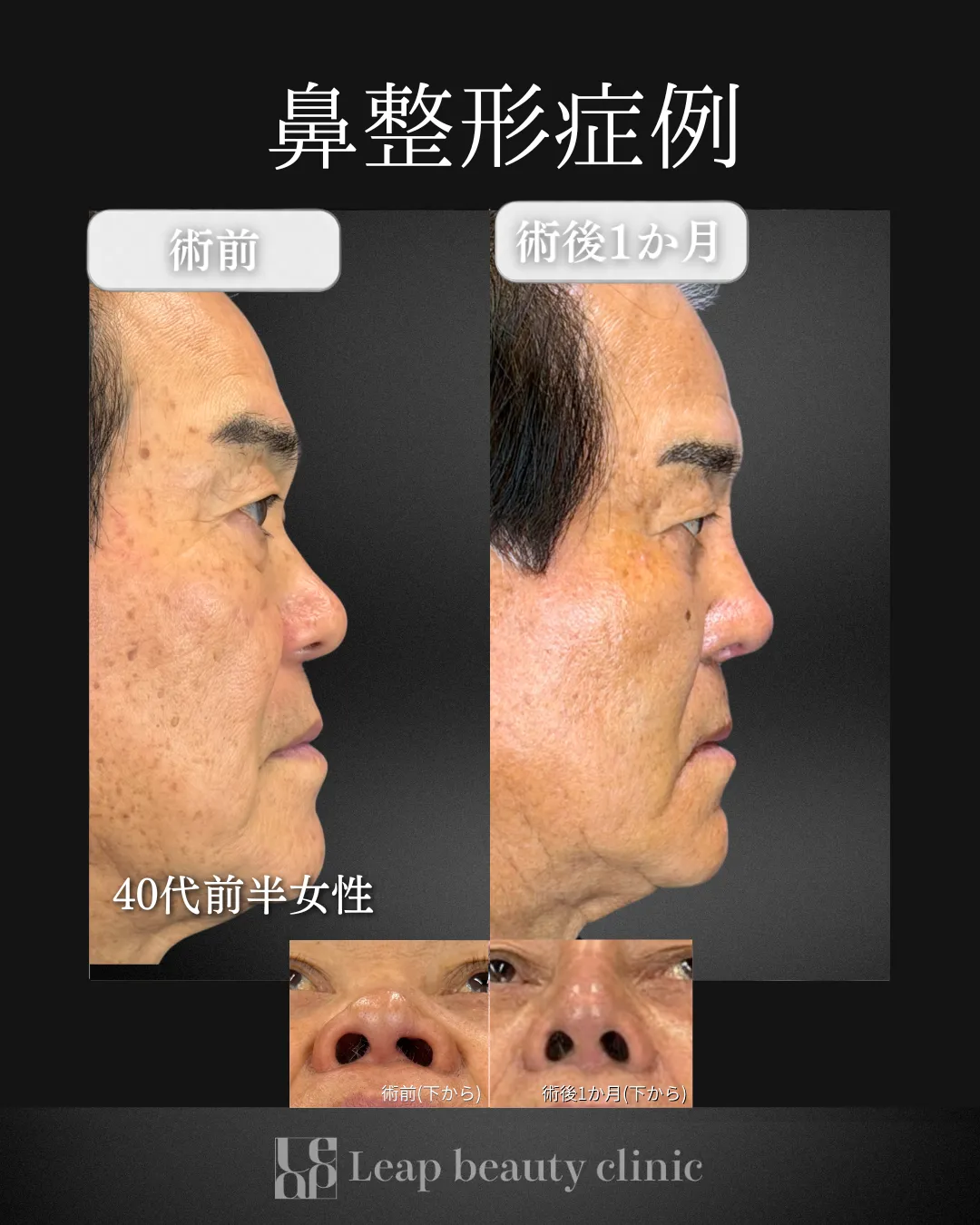 宇都宮院の鼻整形の症例写真3