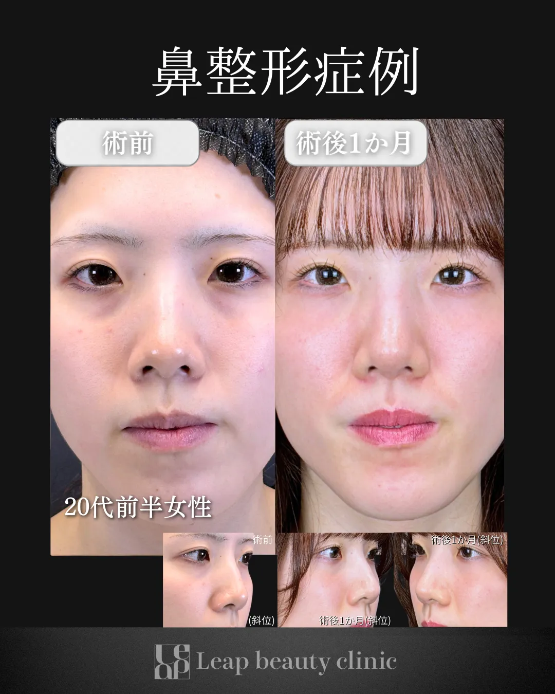 宇都宮院の鼻整形の症例写真4