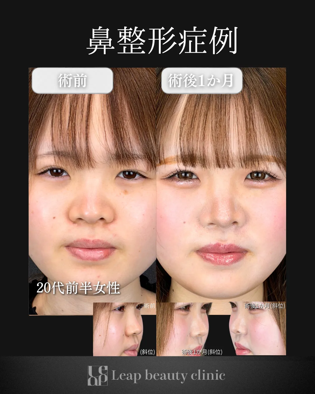 宇都宮院の鼻整形の症例写真5
