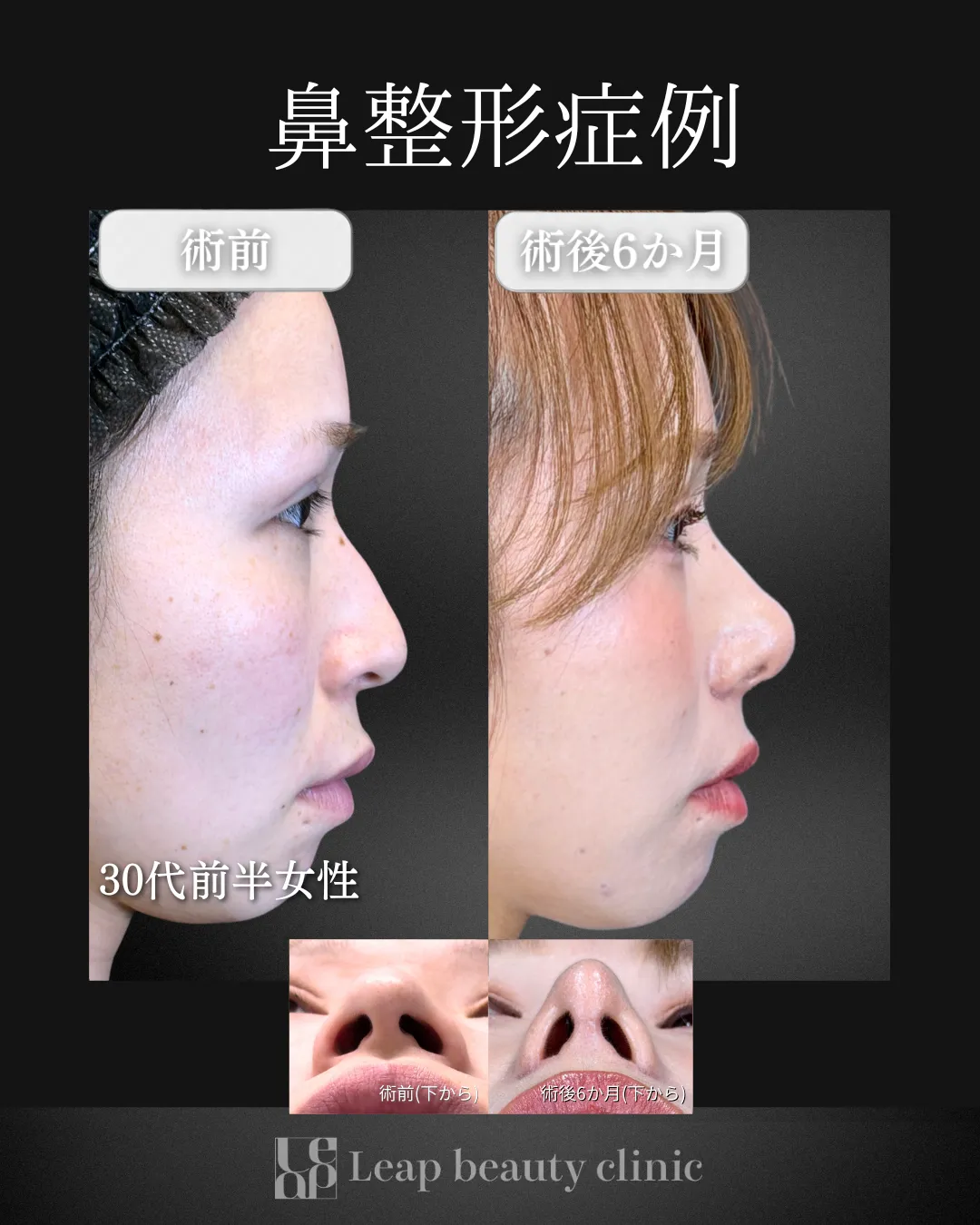 宇都宮院の鼻整形の症例写真6