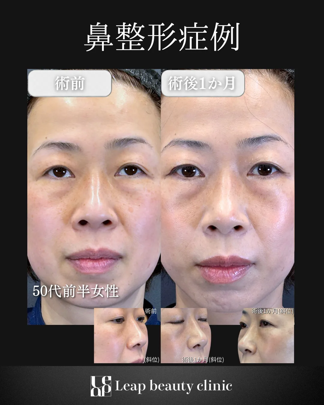 宇都宮院の鼻整形の症例写真7