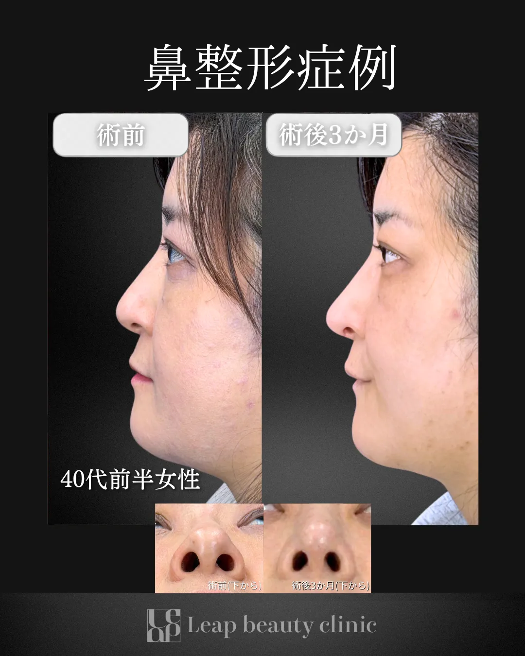 宇都宮院の鼻整形の症例写真8