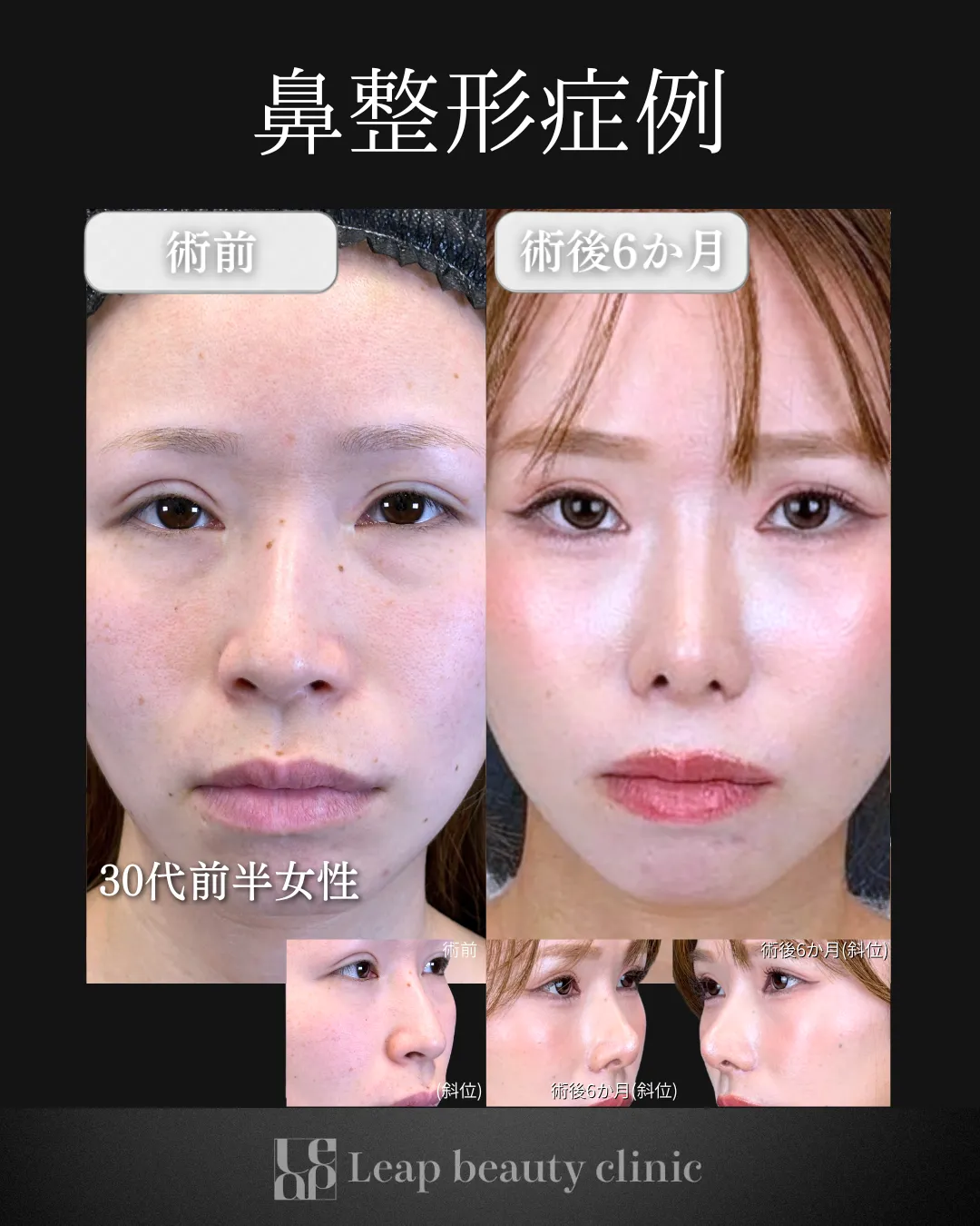 宇都宮院の鼻整形の症例写真9