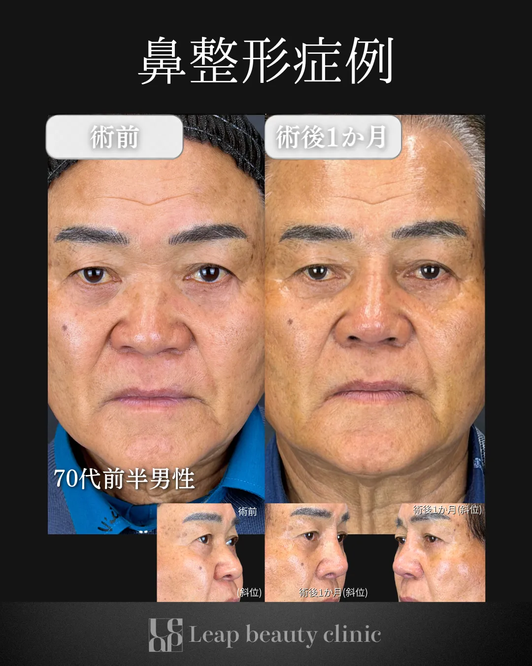 宇都宮院の鼻整形の症例写真10
