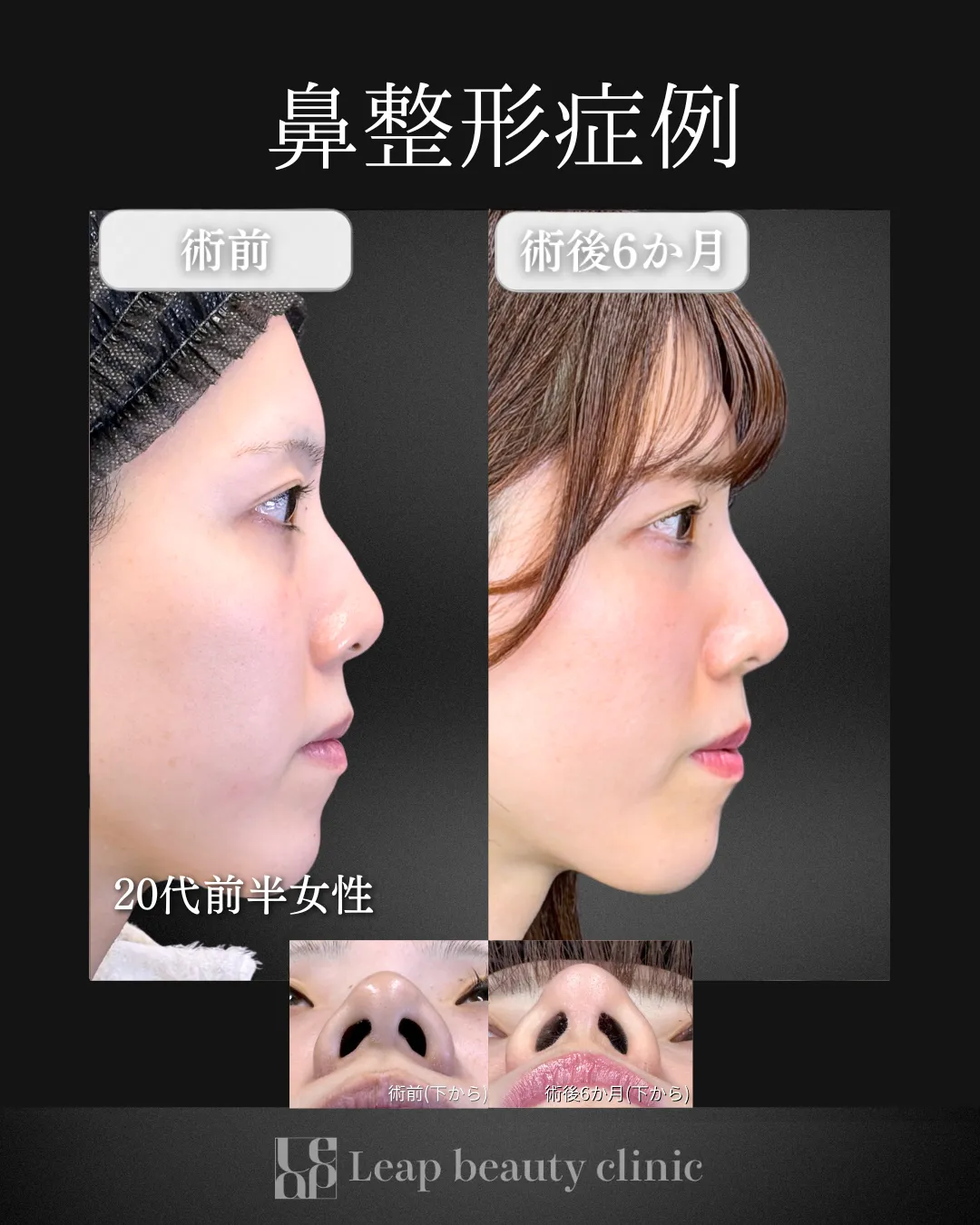 宇都宮院の鼻整形の症例写真11