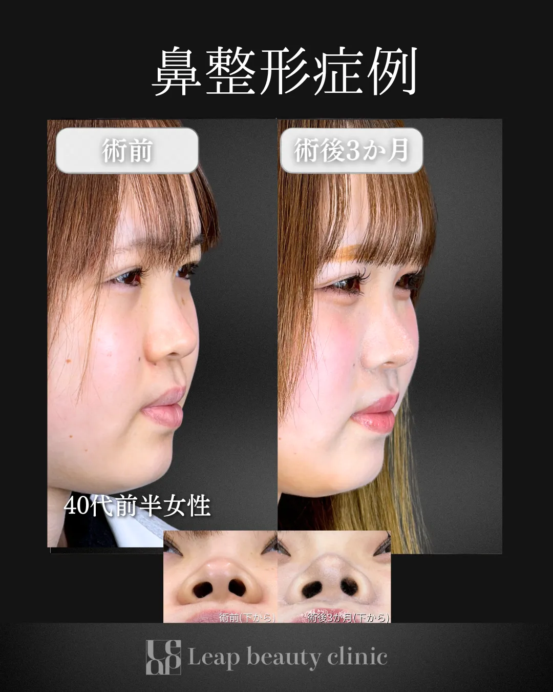 宇都宮院の鼻整形の症例写真12