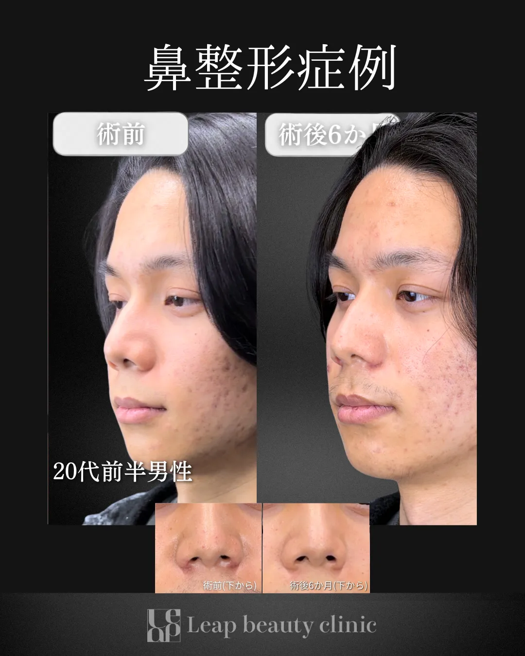 宇都宮院の鼻整形の症例写真20
