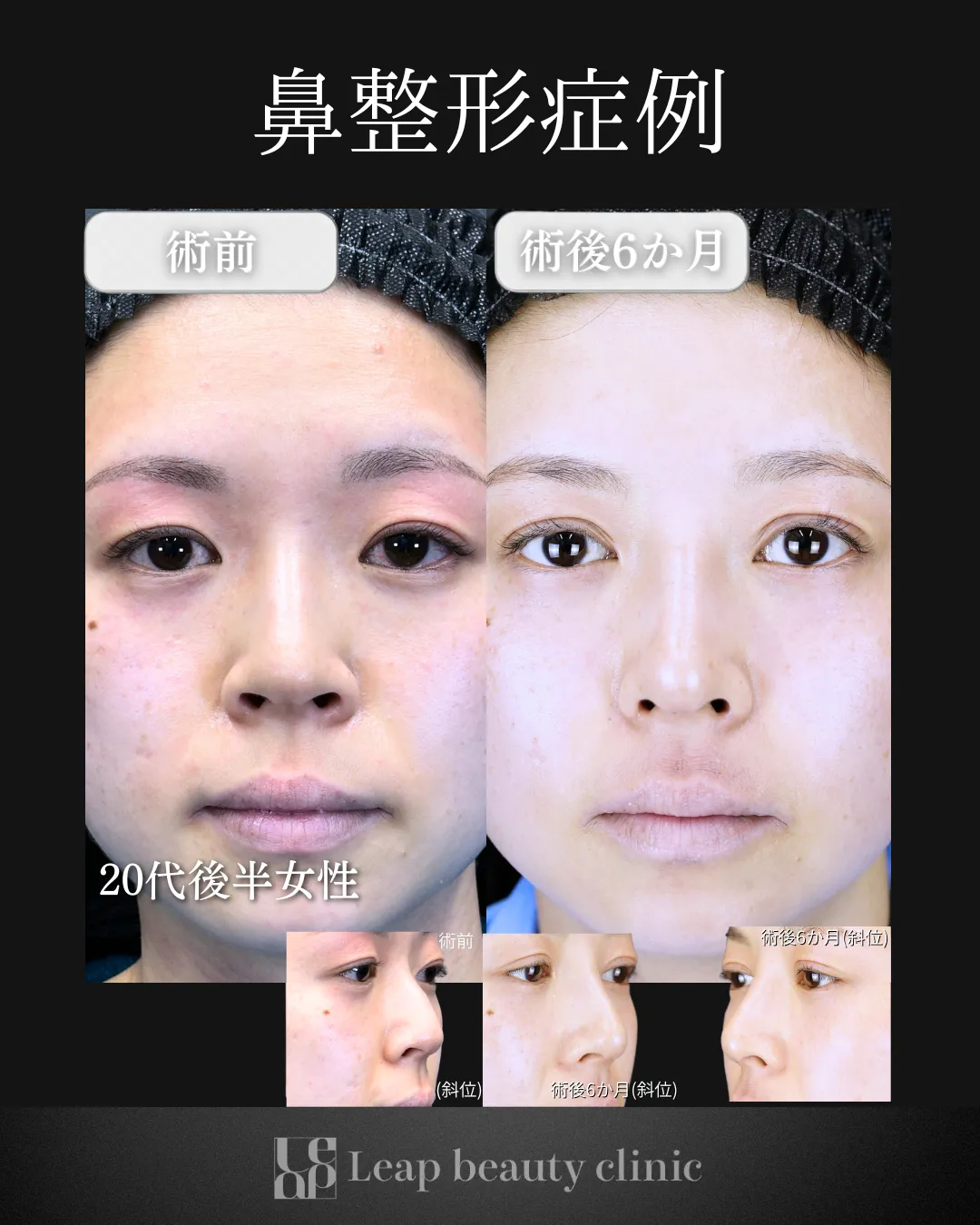 宇都宮院の鼻整形の症例写真21