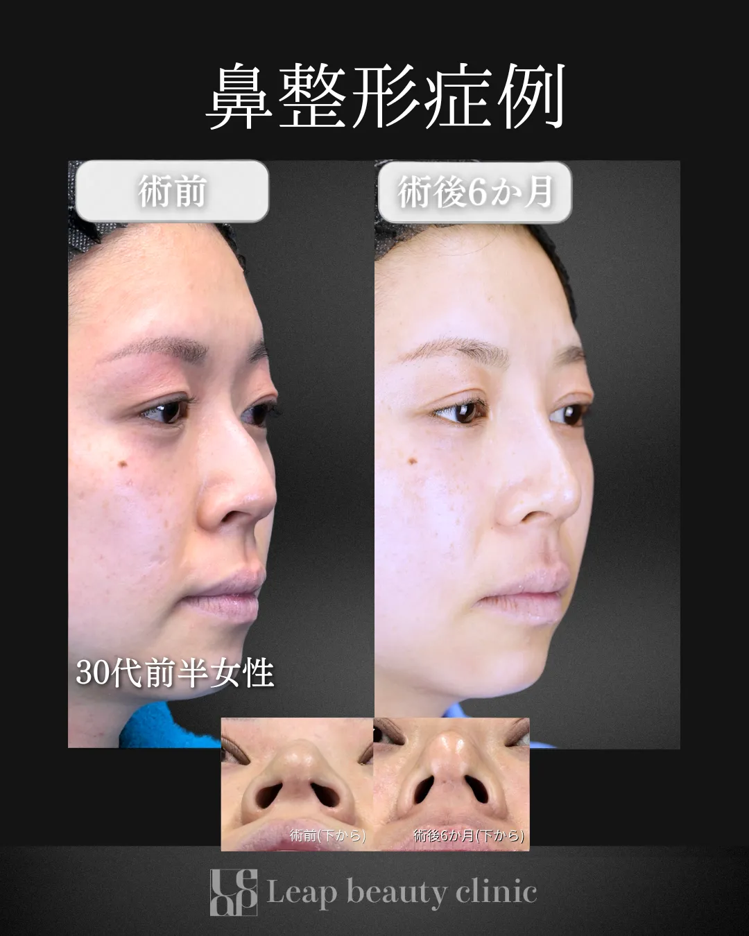 宇都宮院の鼻整形の症例写真22