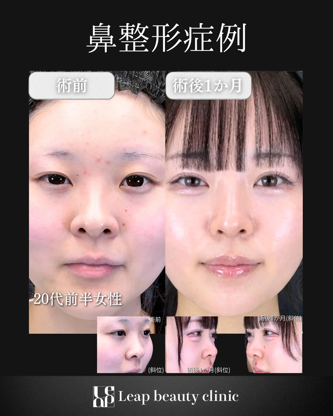 宇都宮院の鼻整形の症例写真15