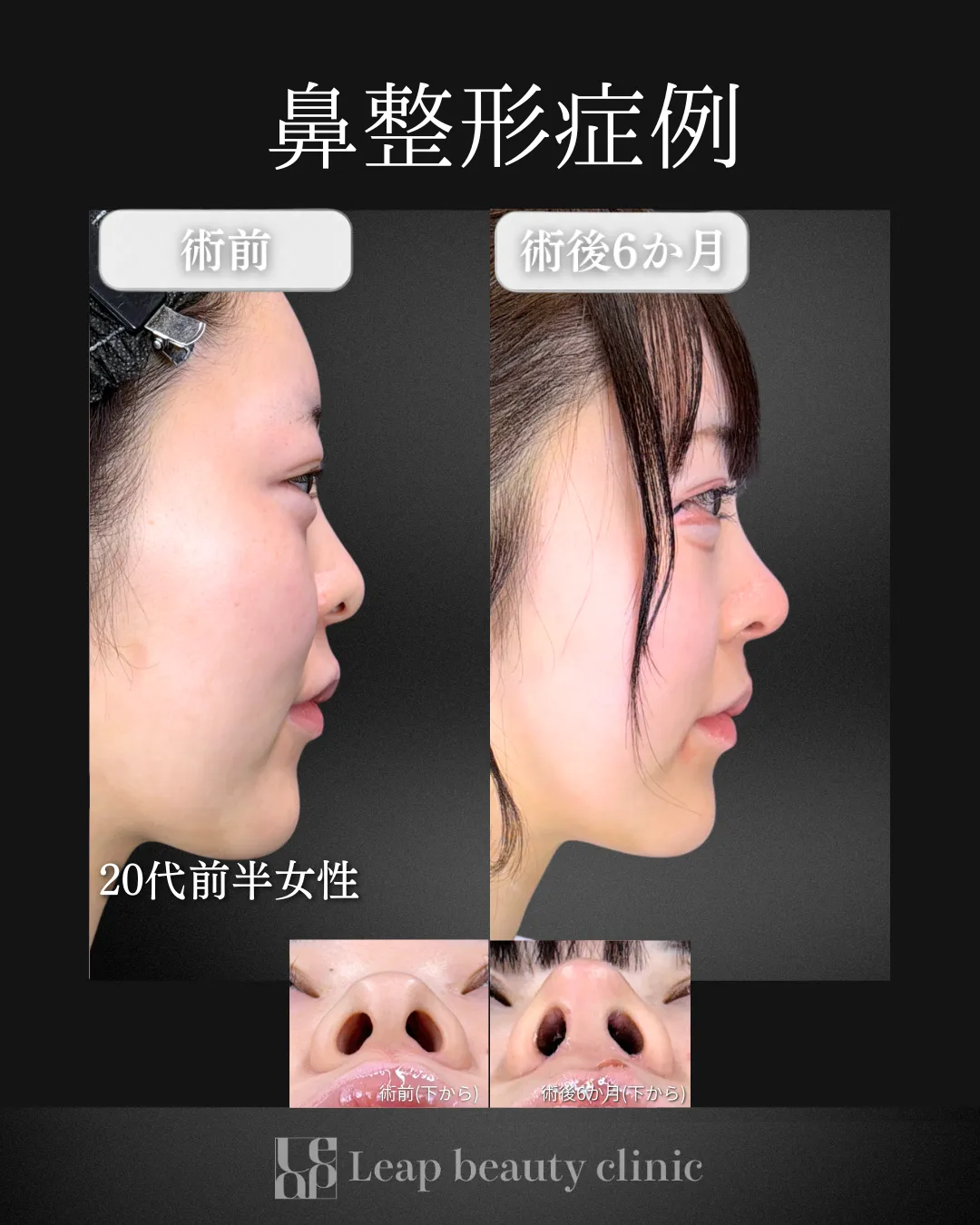 宇都宮院の鼻整形の症例写真16