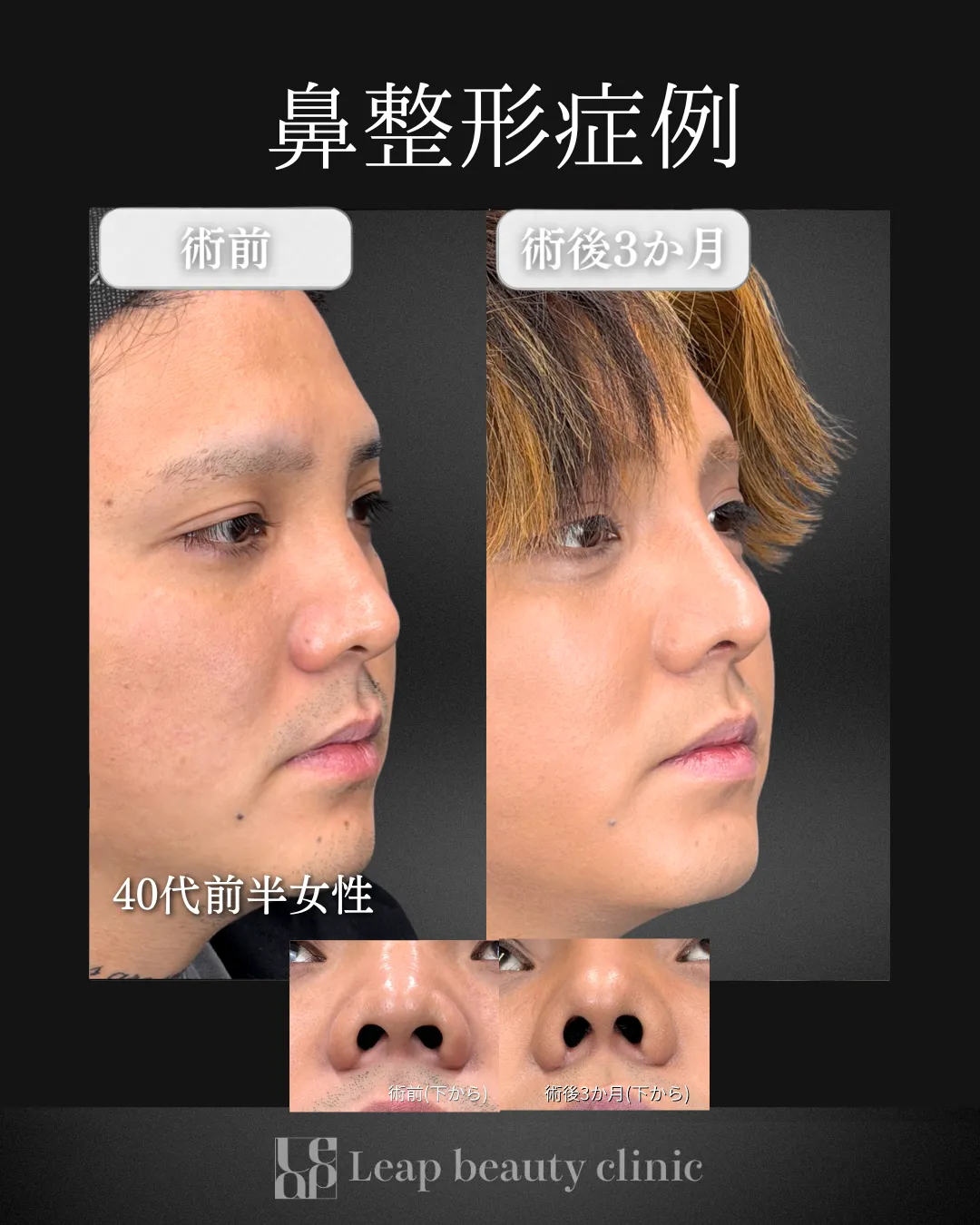 宇都宮院の鼻整形の症例写真17