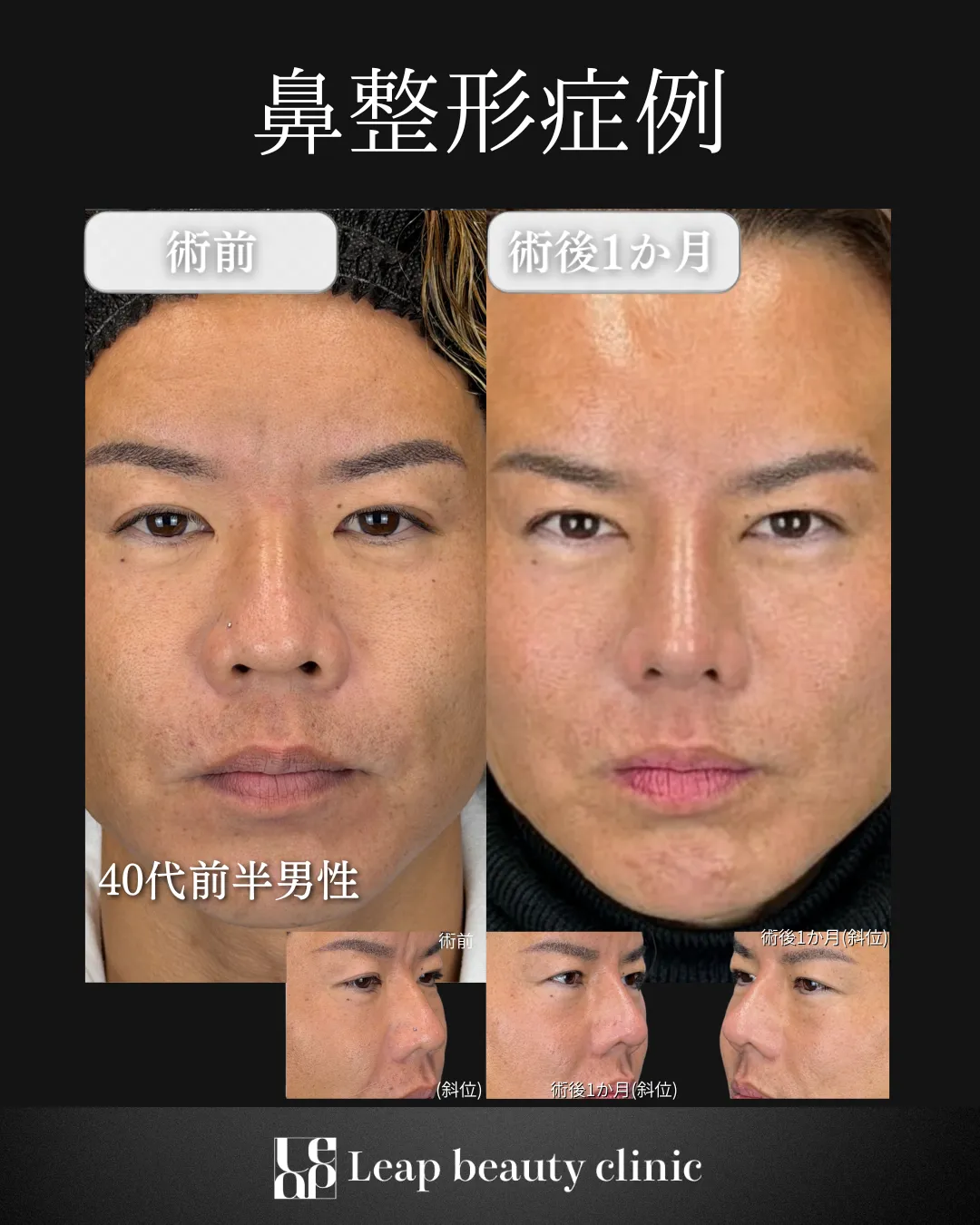 宇都宮院の鼻整形の症例写真18