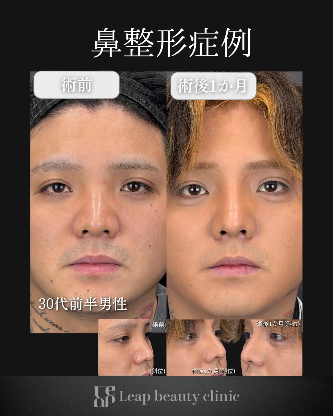 宇都宮院の鼻整形の症例写真19