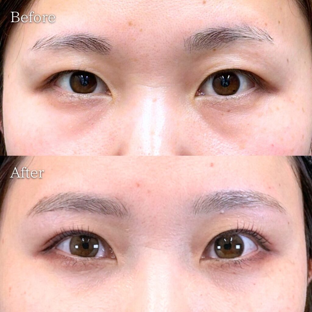 二重埋没法(奥二重)の症例写真 術前・術後