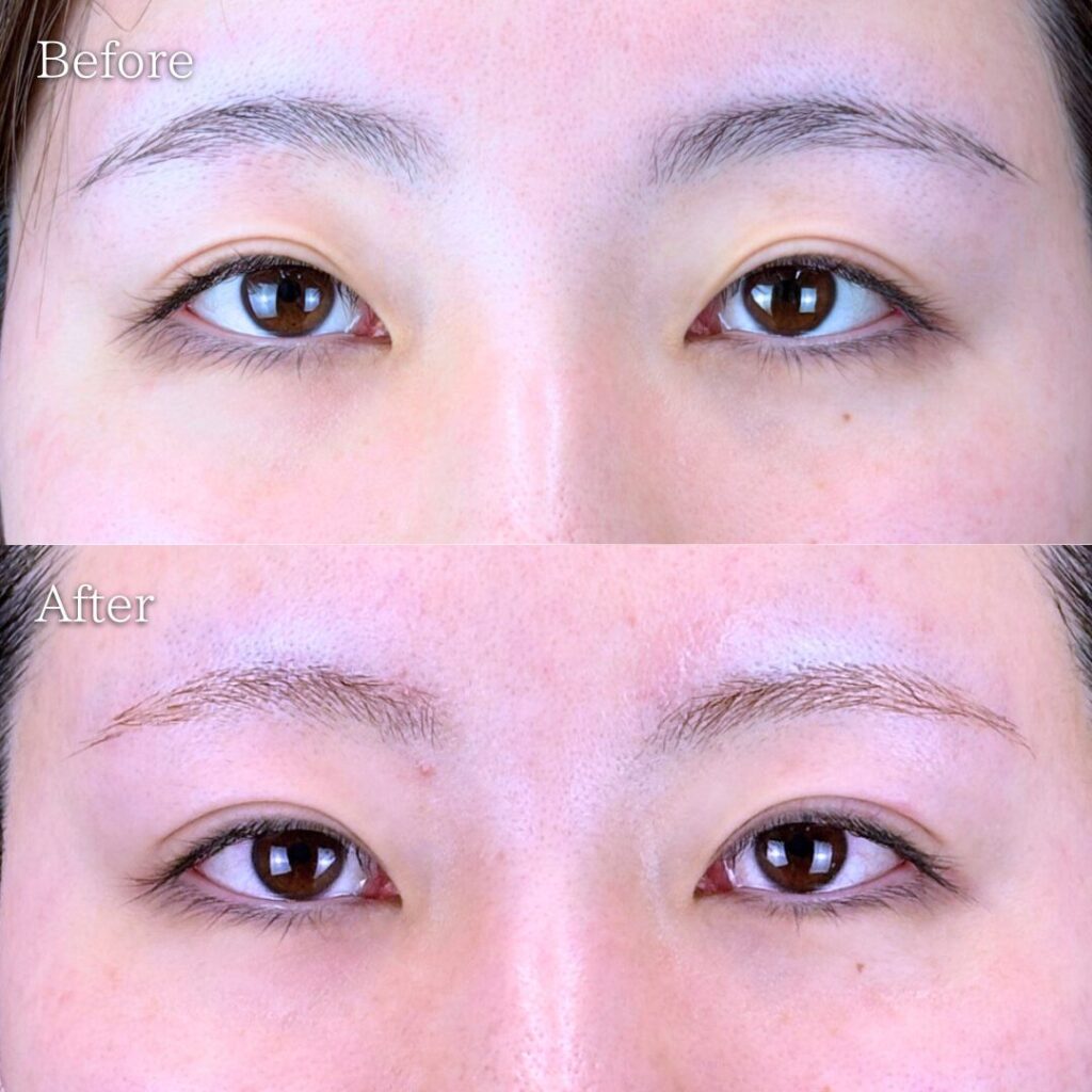 二重埋没法(末広型)の症例写真 術前・術後