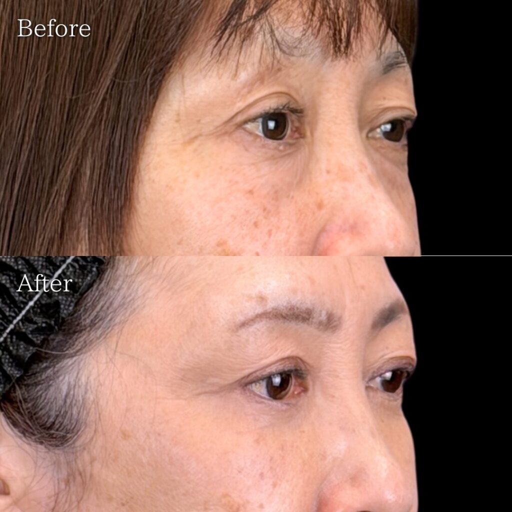 宇都宮院の表ハムラ法の症例写真 50代女性