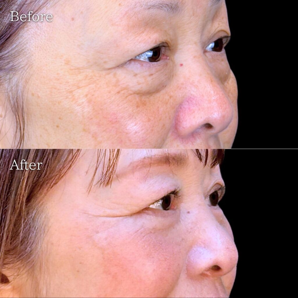 宇都宮院の表ハムラ法の症例写真 60代女性