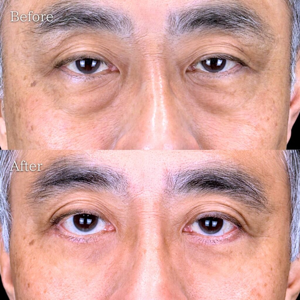 宇都宮院の表ハムラ法の症例写真 50代男性