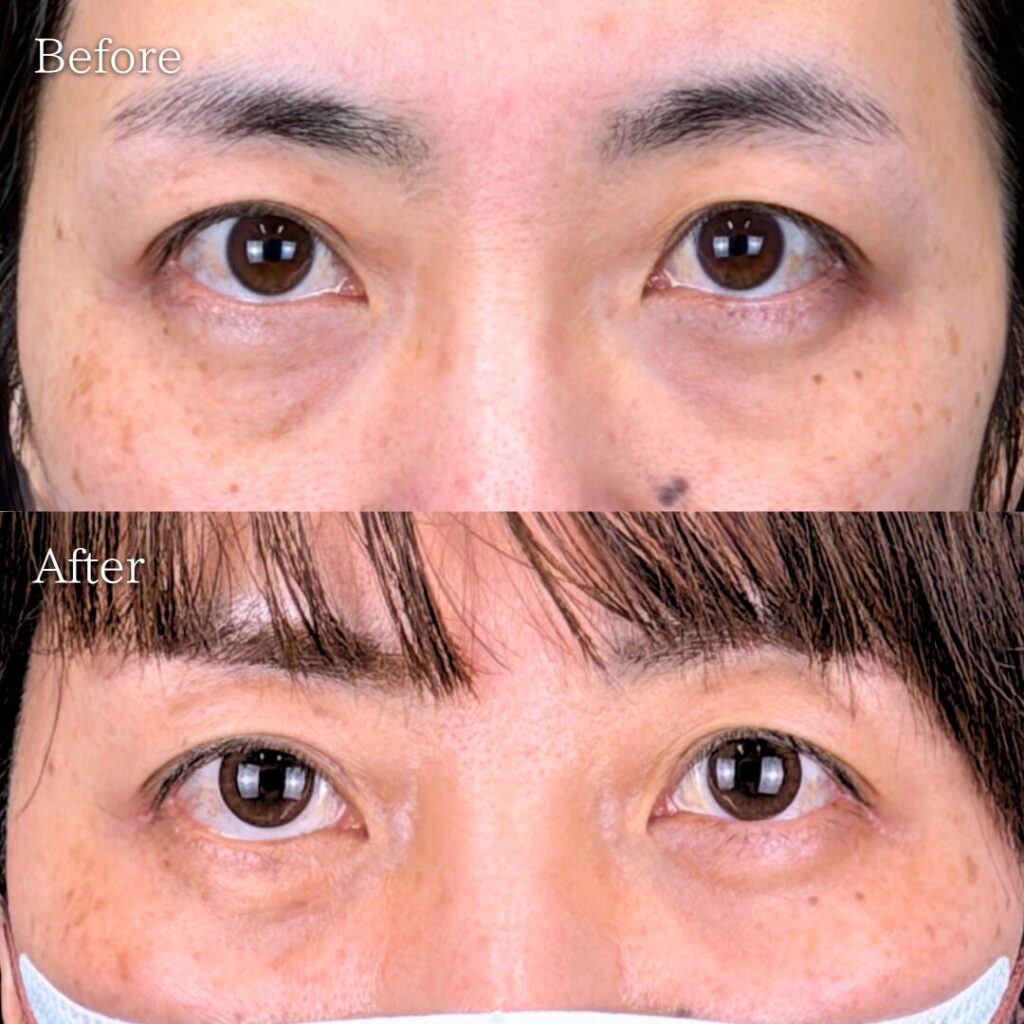 宇都宮院の裏ハムラ法の症例写真 40代女性