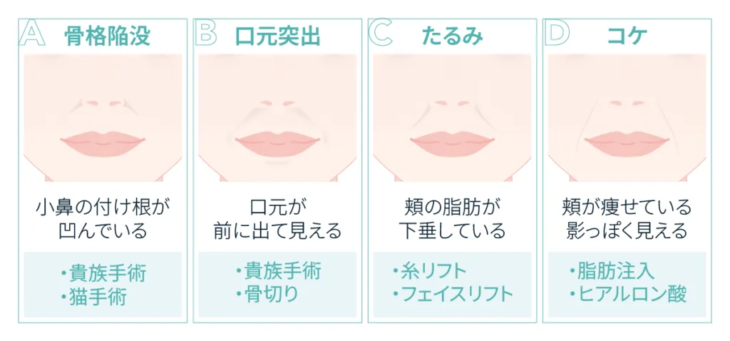ほうれい線のタイプと候補になる施術の図（Leap beauty clinic）